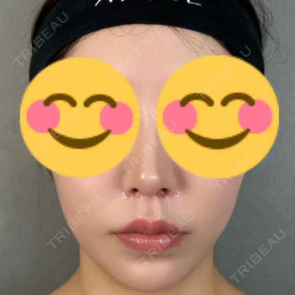 鼻尖形成（切開） / 人中短縮 / 鼻孔縁挙上 / その他（鼻） アリエル美容クリニック 大宮院 AFTER メイン用