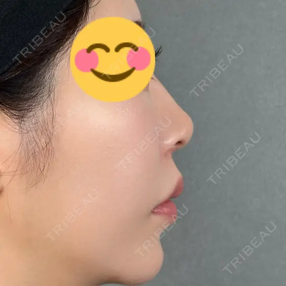 鼻尖形成（切開） / 人中短縮 / 鼻孔縁挙上 / その他（鼻） アリエル美容クリニック 大宮院 DAY 441 メイン用