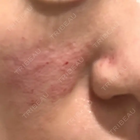 キュアジェット レナータクリニック 立川院 DAY 0 メイン用