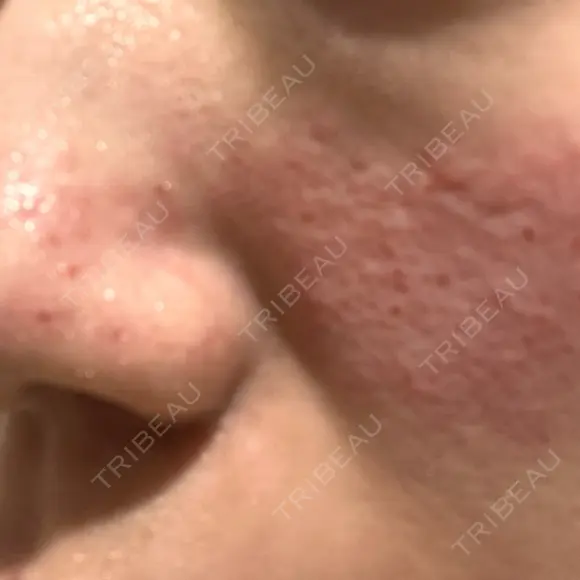 キュアジェット レナータクリニック 立川院 DAY 0 メイン用