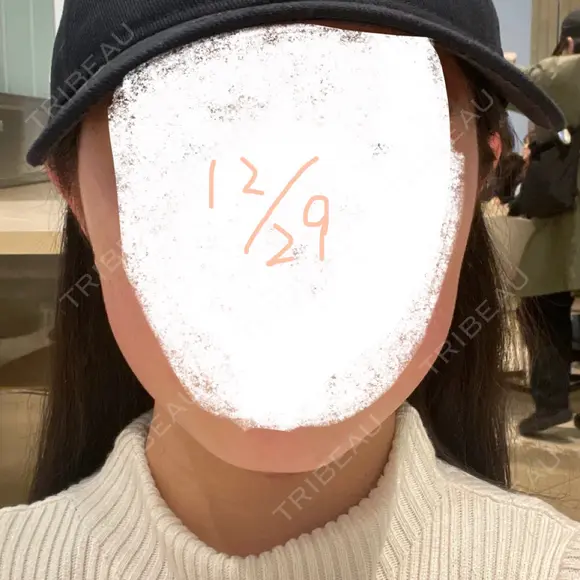 ボトックス（エラ・小顔） 東京美容皮膚科アロエクリニック池袋 AFTER メイン用