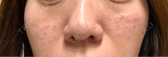 キュアジェット レナータクリニック 立川院 DAY 0 メイン用