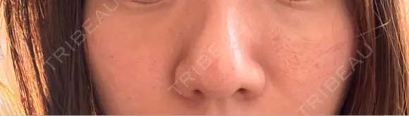 キュアジェット レナータクリニック 立川院 DAY 1 メイン用