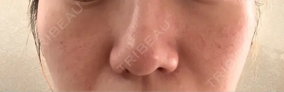 キュアジェット レナータクリニック 立川院 DAY 2 メイン用