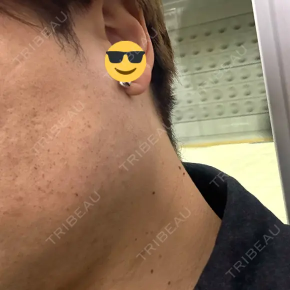 ボトックス（エラ・小顔） BiBiクリニック AFTER メイン用