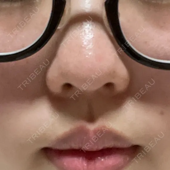 ピコレーザートーニング（美白・肝斑） 東京美容皮膚科アロエクリニック池袋 DAY 7 メイン用