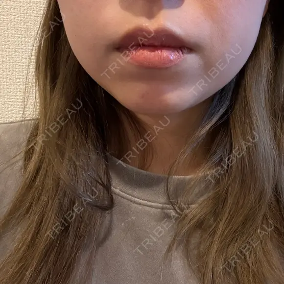 ボトックス（エラ・小顔） / インモード Moon Beauty Clinic DAY 4 メイン用