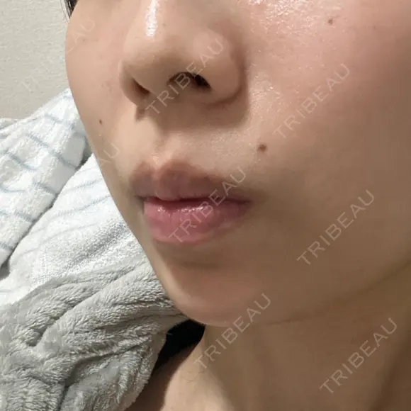 ボトックス（あご） / 肌ヒアルロン酸注入（たるみ・シワ改善） BIZENNクリニック【ビゼンクリニック】 DAY 8 メイン用