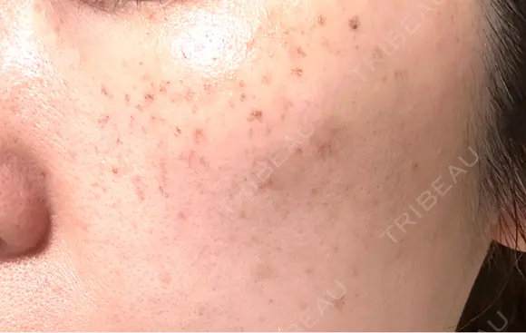 イオン導入 / ピーリング（ハリ・ツヤ） / ルメッカ ルラ美容クリニック 福岡本院 DAY 1 メイン用