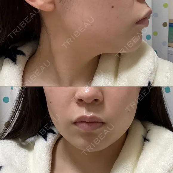 ボトックス（エラ・小顔） BiBiクリニック AFTER メイン用