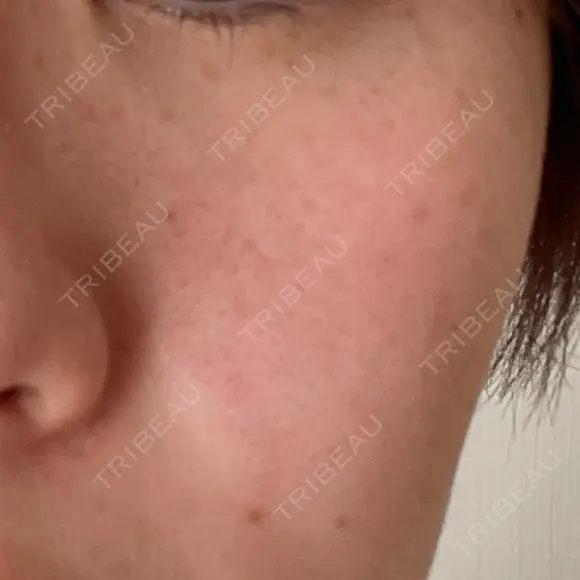 ピコレーザートーニング（美白・肝斑） 東京美容皮膚科アロエクリニック池袋 DAY 8 メイン用