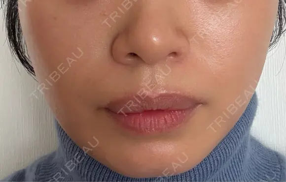 ピーリング（ニキビ・毛穴） Clara CLINIC 美容皮膚科・歯科 DAY 2 メイン用