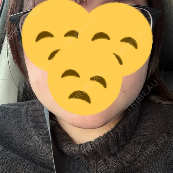 ボトックス（エラ・小顔） フィラークリニック 大阪心斎橋院 DAY 1 メイン用