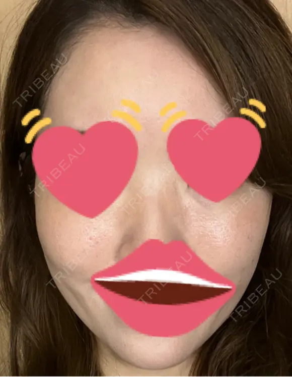 脂肪注入（肌） 日本ウェルネス再生クリニック DAY 3 メイン用