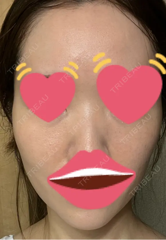 脂肪注入（肌） 日本ウェルネス再生クリニック DAY 4 メイン用