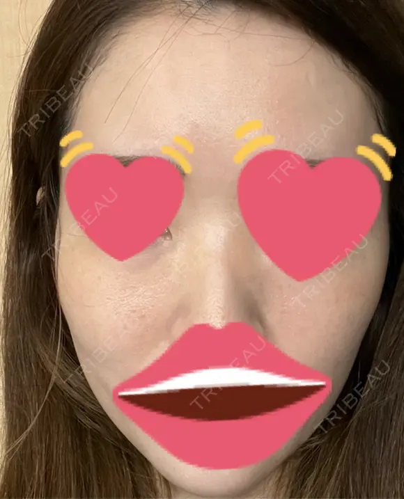 脂肪注入（肌） 日本ウェルネス再生クリニック DAY 6 メイン用