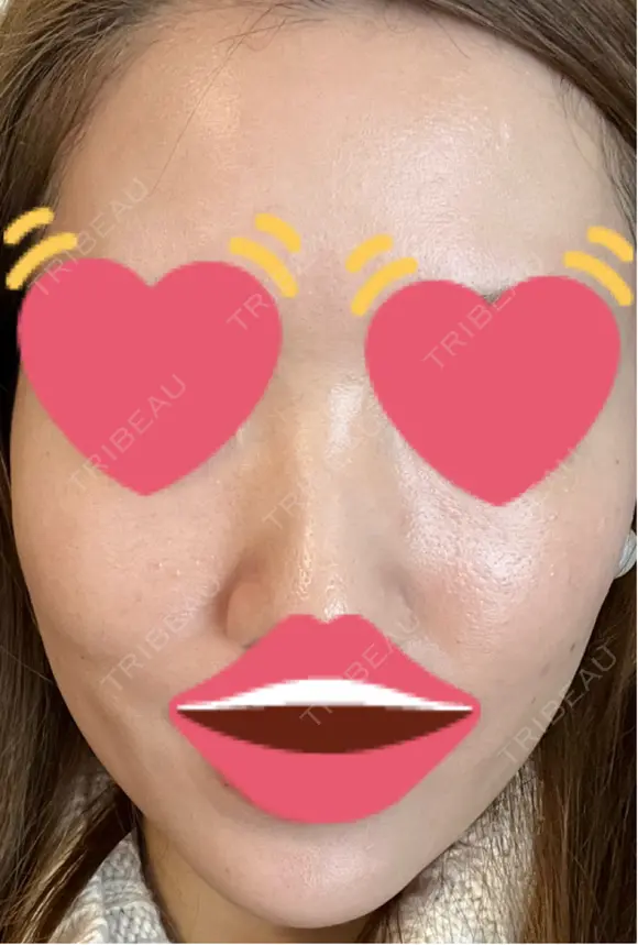 脂肪注入（肌） 日本ウェルネス再生クリニック DAY 8 メイン用