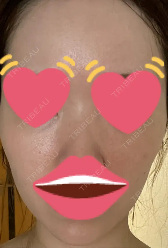 脂肪注入（肌） 日本ウェルネス再生クリニック AFTER メイン用