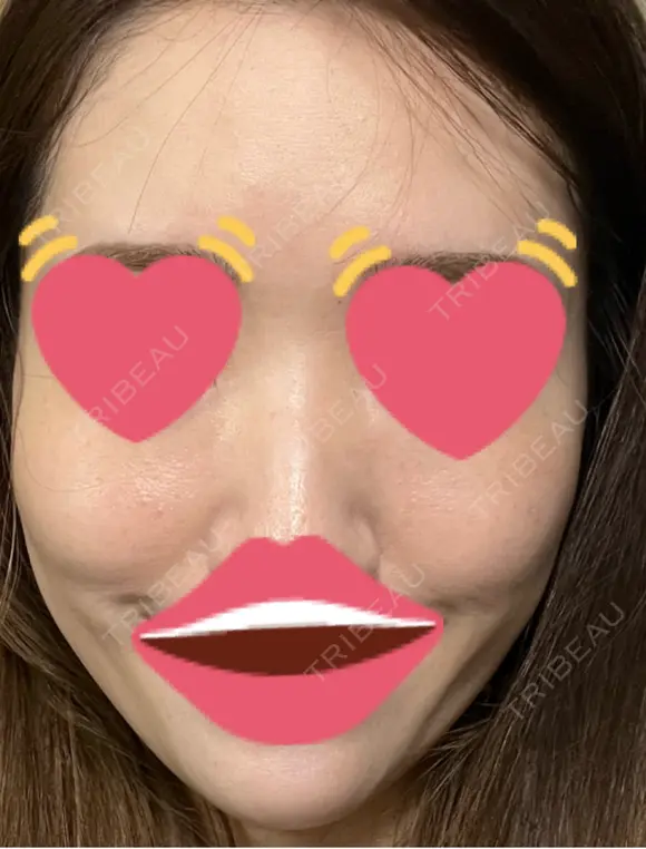 脂肪注入（肌） 日本ウェルネス再生クリニック DAY 2 メイン用