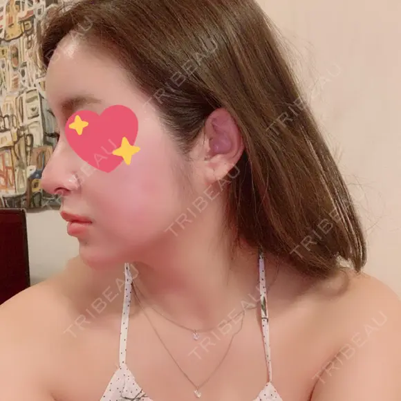 鼻尖形成（切開） / 鼻中隔延長（切開） / 脂肪注入（額） / 脂肪注入（輪郭） ビーザニュー美容整形外科（旧コノピ美容整形外科） DAY 57 メイン用