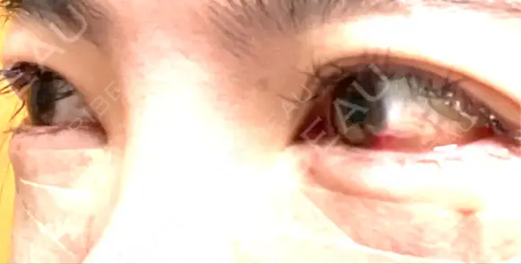 クマ治療 KIMI CLINIC 形成・美容外科 DAY 1 メイン用