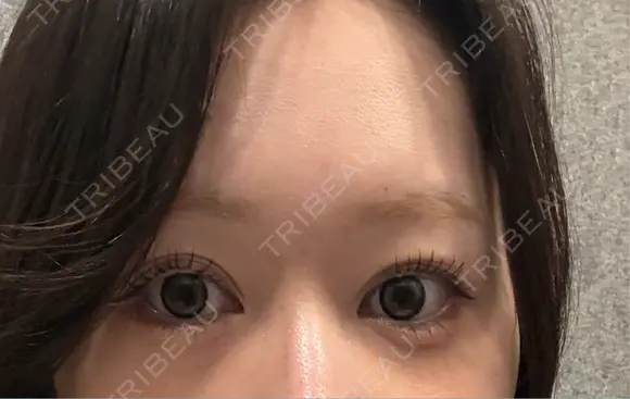二重埋没 / 目尻切開 / 自然癒着法 Stand by Beauty Clinic DAY 74 メイン用