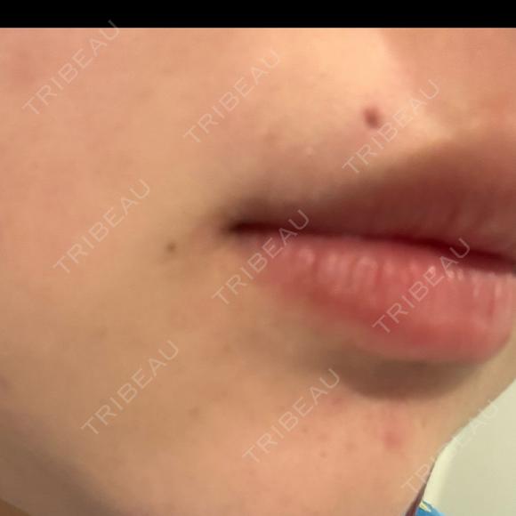 ほくろ・いぼ切除（肌） R Beauty CLINIC 名古屋院 DAY 3 メイン用