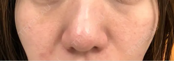 キュアジェット レナータクリニック 立川院 DAY 3 メイン用