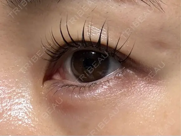 ヒアルロン酸注入（涙袋） 静岡中央クリニック DAY 1 メイン用