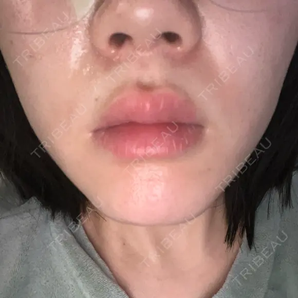 医療脱毛（顔） 共立美容外科 立川院 AFTER メイン用