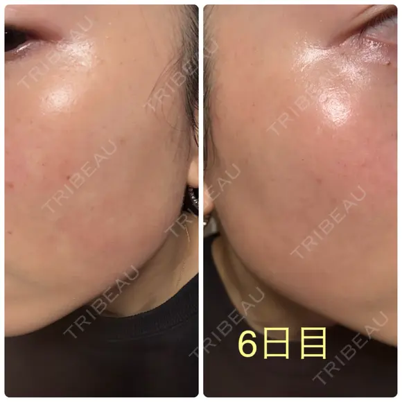 ピーリング（ニキビ・毛穴） / イオン導入 / ルメッカ ルラ美容クリニック 札幌本院 AFTER メイン用