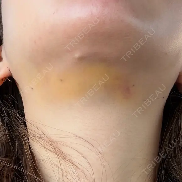 糸リフト / 脂肪吸引（顔） / 水光注射（ハリ・美肌） Wing clinic 豊中駅前院 DAY 7 メイン用