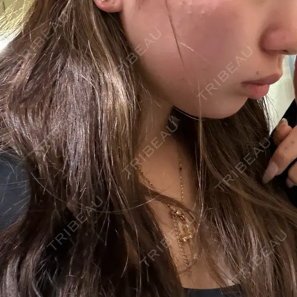 糸リフト / 脂肪吸引（顔） / 水光注射（ハリ・美肌） Wing clinic 豊中駅前院 DAY 7 メイン用