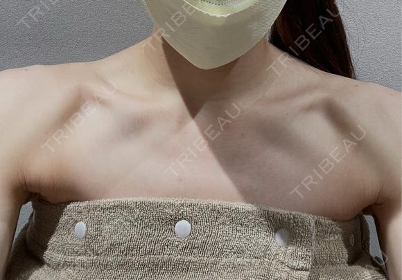 ボトックス（肩） BITO BEAUTY CLINIC DAY 0 メイン用