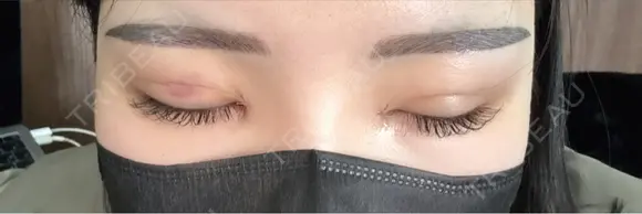 二重埋没 / 目頭切開 東京シンデレラ美容外科 池袋院 DAY 1 メイン用