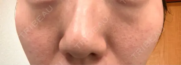 キュアジェット レナータクリニック 立川院 AFTER メイン用