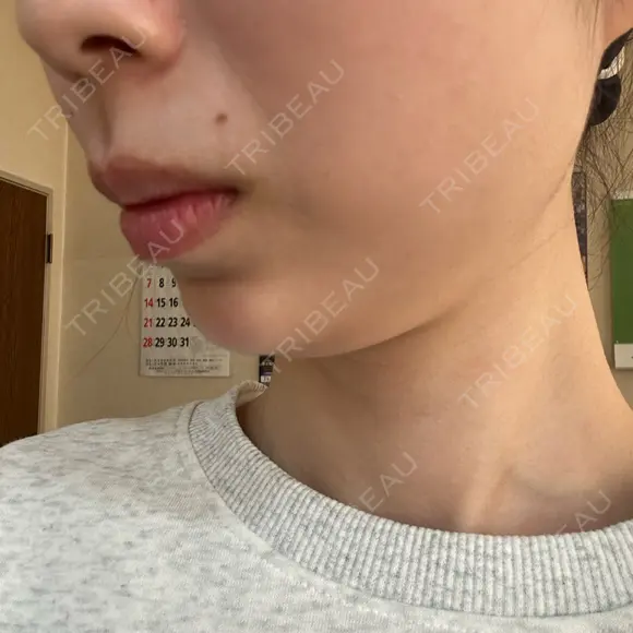 ボトックス（あご） / 肌ヒアルロン酸注入（たるみ・シワ改善） BIZENNクリニック【ビゼンクリニック】 DAY 11 メイン用