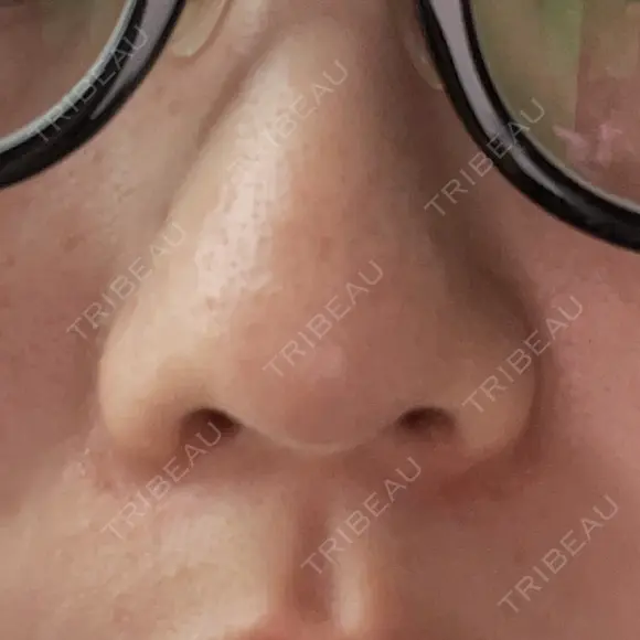 ピコレーザートーニング（美白・肝斑） 東京美容皮膚科アロエクリニック池袋 DAY 10 メイン用