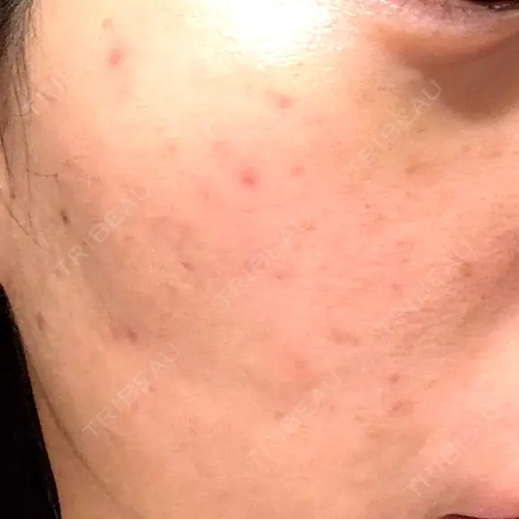 水光注射（ハリ・美肌） / 毛穴洗浄（ハイドラフェイシャルなど） RIN BEAUTY CLINIC DAY 7 メイン用