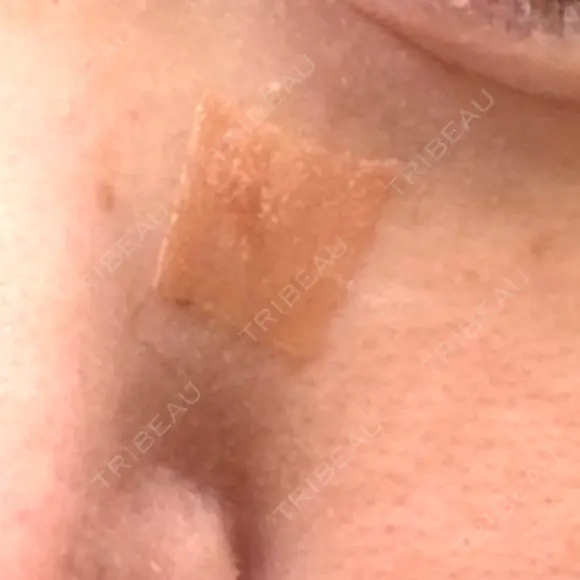 ほくろ・いぼ除去レーザー（肌） 心斎橋KT美容クリニック DAY 7 メイン用