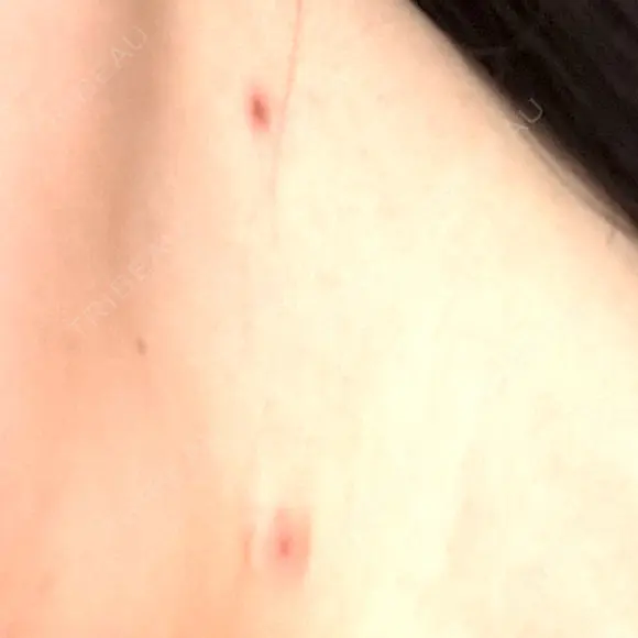 ほくろ・いぼ除去レーザー（肌） 心斎橋KT美容クリニック DAY 7 メイン用