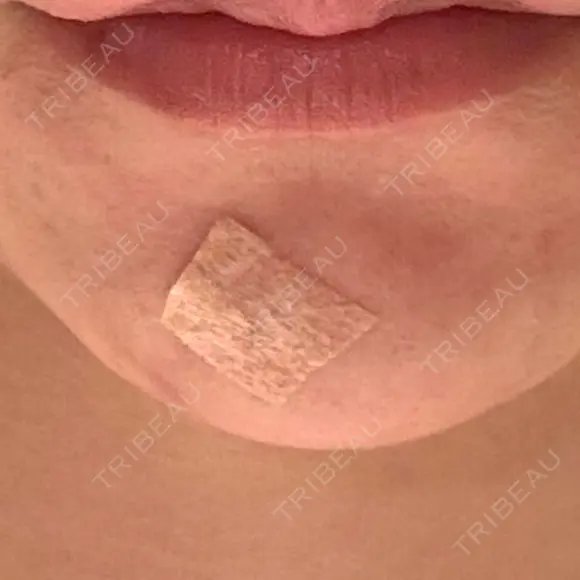 ほくろ・いぼ除去レーザー（肌） 心斎橋KT美容クリニック DAY 7 メイン用