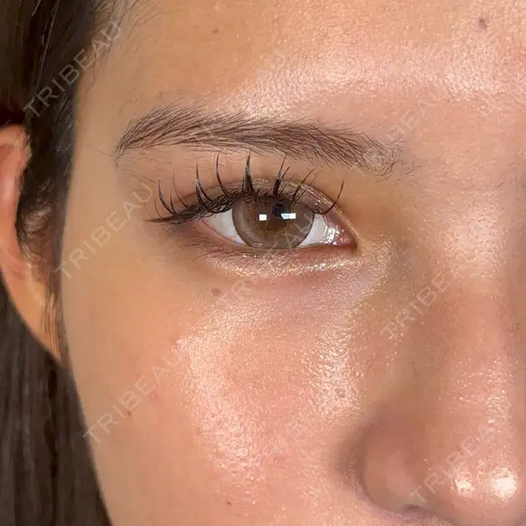 二重埋没 / 上まぶたの脂肪取り / 口角挙上 / ヒアルロン酸注入（涙袋） / ボトックス（エラ・小顔） / ヒアルロン酸注入（唇） / ボトックス（肩） アリエル美容クリニック 大宮院 DAY 7 メイン用