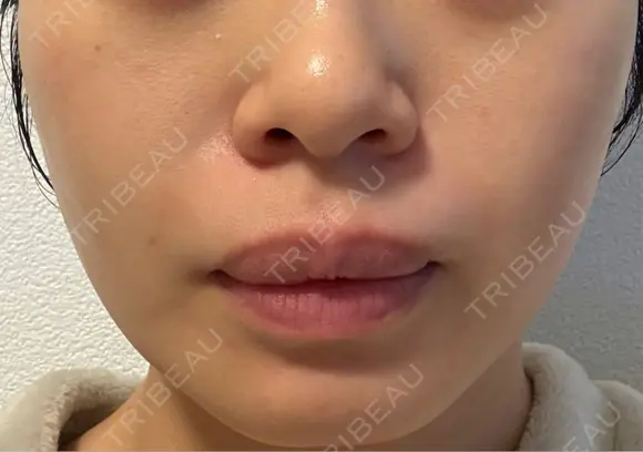 ピーリング（ニキビ・毛穴） Clara CLINIC 美容皮膚科・歯科 AFTER メイン用
