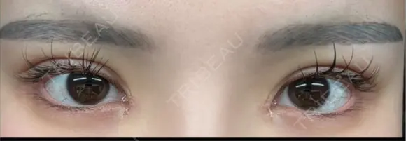 二重埋没 / 目頭切開 東京シンデレラ美容外科 池袋院 DAY 8 メイン用