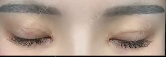 二重埋没 / 目頭切開 東京シンデレラ美容外科 池袋院 DAY 8 メイン用