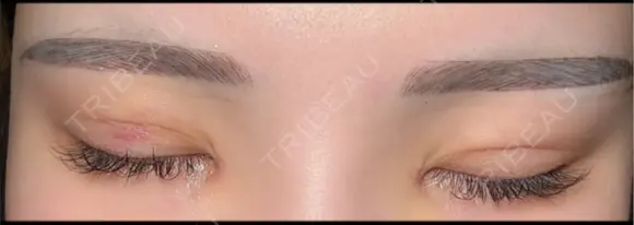 二重埋没 / 目頭切開 東京シンデレラ美容外科 池袋院 DAY 5 メイン用