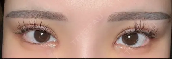 二重埋没 / 目頭切開 東京シンデレラ美容外科 池袋院 DAY 5 メイン用