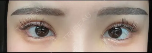 二重埋没 / 目頭切開 東京シンデレラ美容外科 池袋院 DAY 3 メイン用