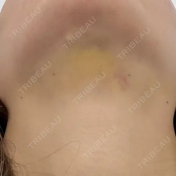 糸リフト / 脂肪吸引（顔） / 水光注射（ハリ・美肌） Wing clinic 豊中駅前院 DAY 10 メイン用